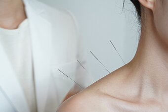 Akupunktur